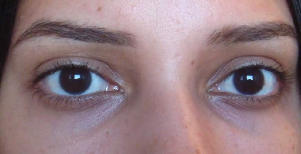 tipos de olheiras