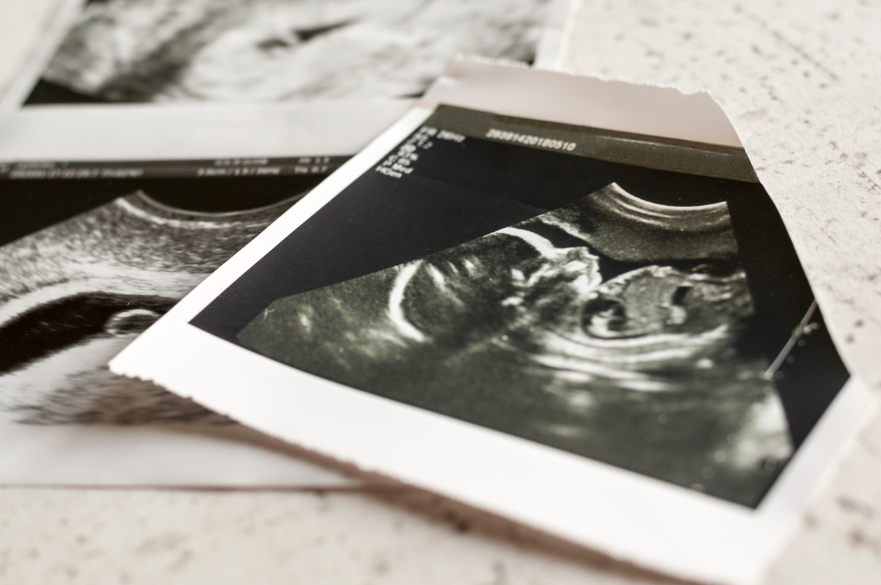20 semanas de gestação: como está o bebê nessa fase? 20 semanas de gestação: como está o bebê nessa fase?